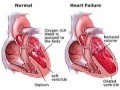 نارسایی قلبی چیست؟