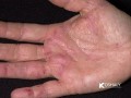 اگر دستانتان اینگونه است شما سرطان دارید!